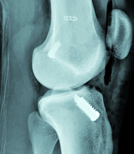 X-ray of one of the implanted new screws, in position, securing the reconstructed tendon to the bone.